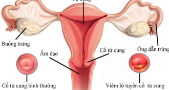 [Kiến thức] 3 cấp độ nặng nhẹ của viêm lộ tuyến cổ tử cung